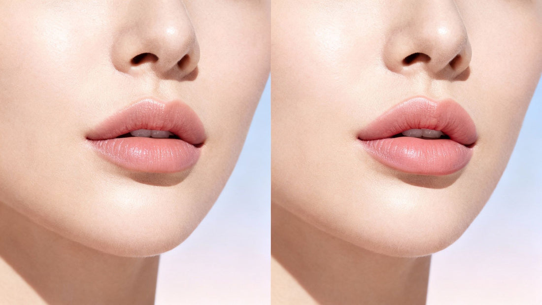 Lip flip botox: The Subtle Way to a Natural-Looking Pout